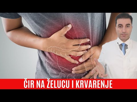 Video: Krvare li čir na dvanaesniku?