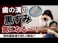 歯の溝の黒ずみ気になる〜！現役歯医者が詳しく解説！
