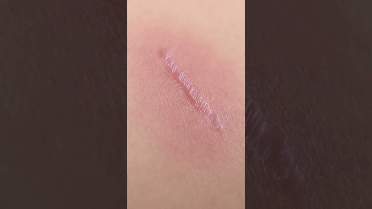 "Skin Defenders: How Your Body Heals Cuts and Wounds | Animated Healing Journey"