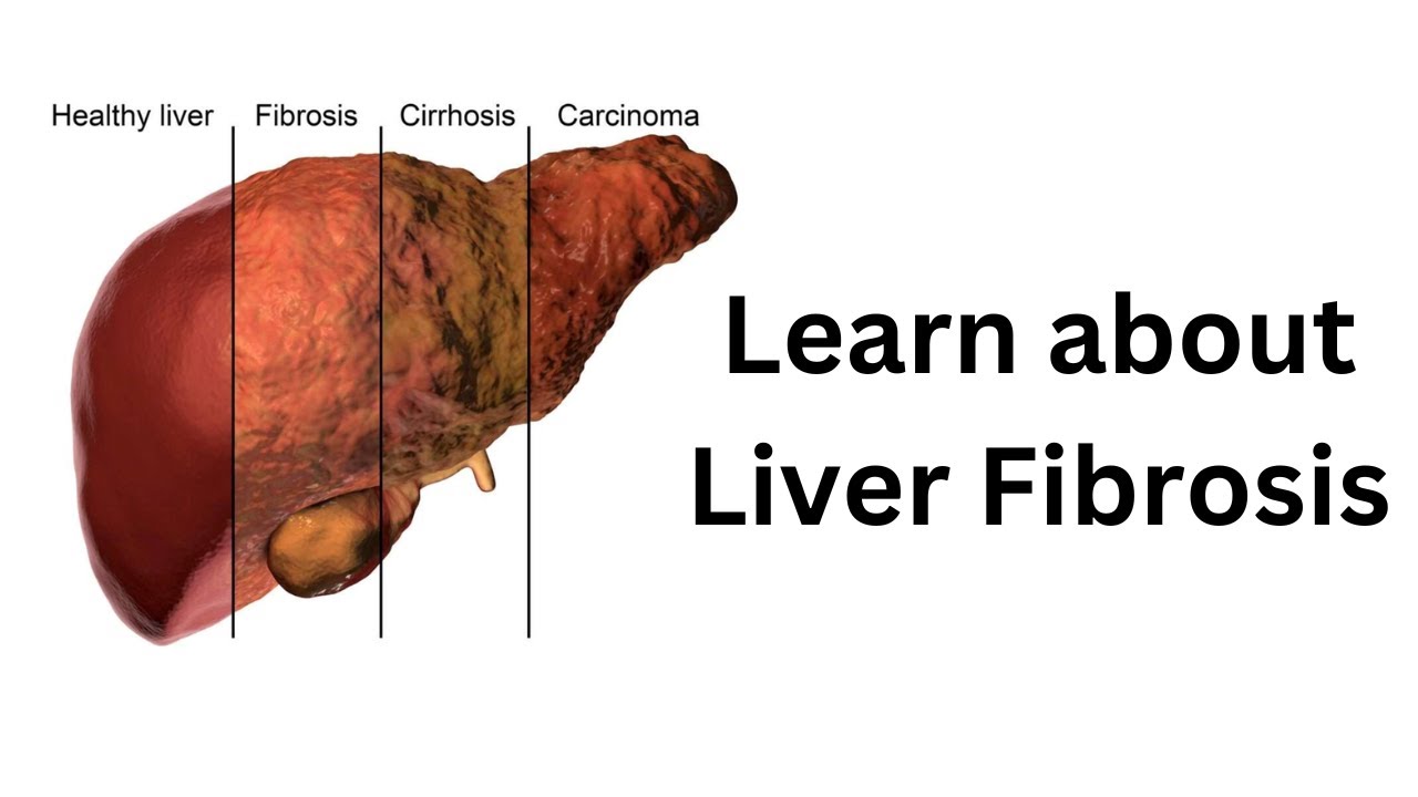 What is liver fibrosis a story of liver fibrosis cirrhosis youtube
