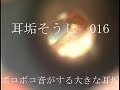 耳垢そうじ/聞こえが悪くてボコボコ音がする耳垢/016