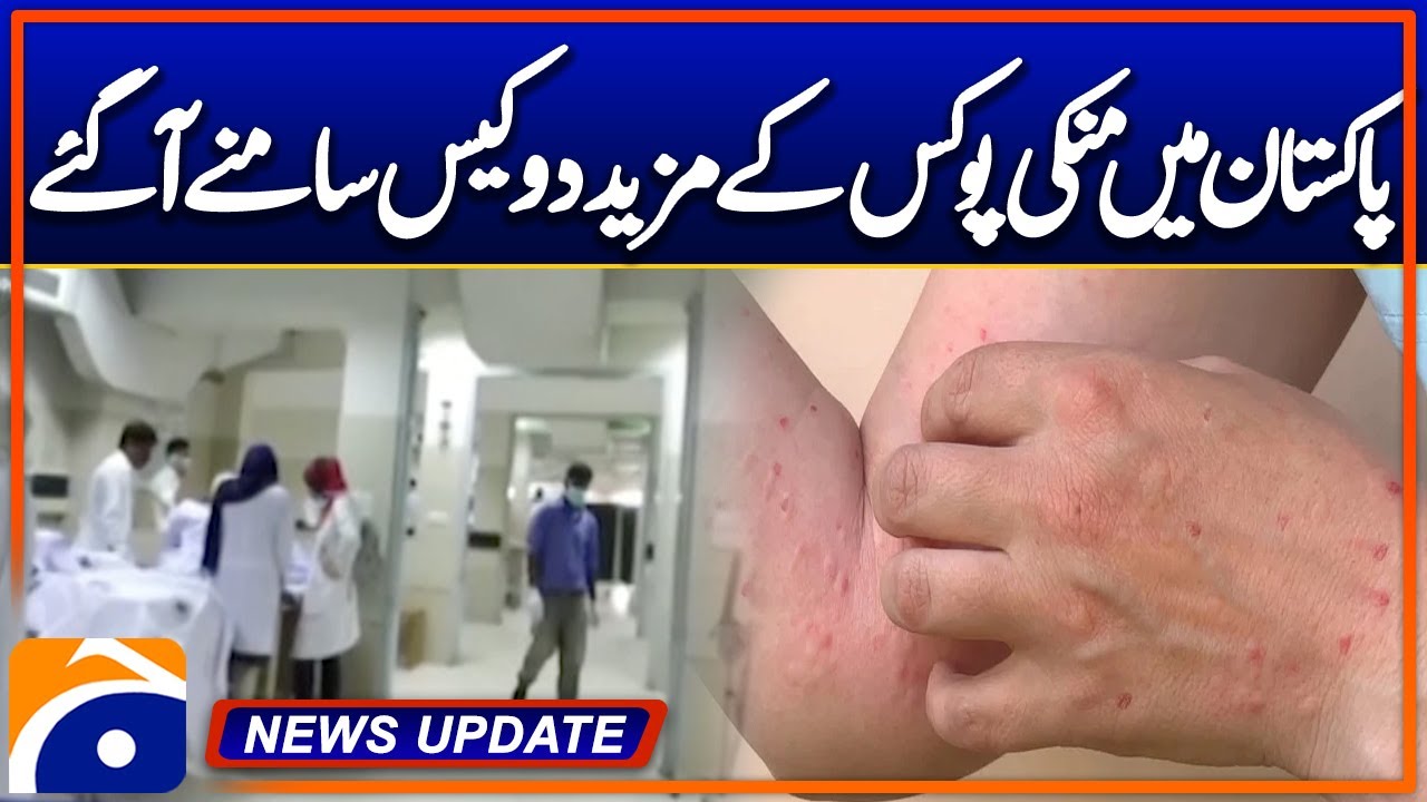 Two more cases of monkeypox have been reported in Pakistan. | Geo News ...