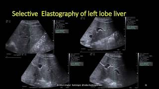 TMT: Elastography by Dr Alka Singhal: Intro to ARFI