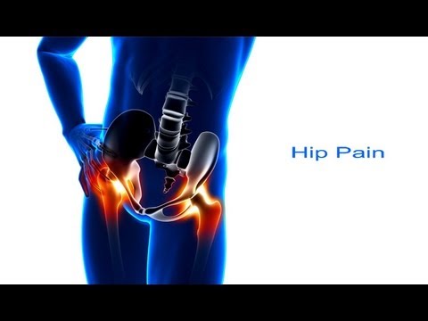 Video: Hip Pain: Příčiny, Léčby A Kdy Hledat Pomoc