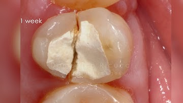 DRendo - Some reflections on the apical limit of instrumentation procedures