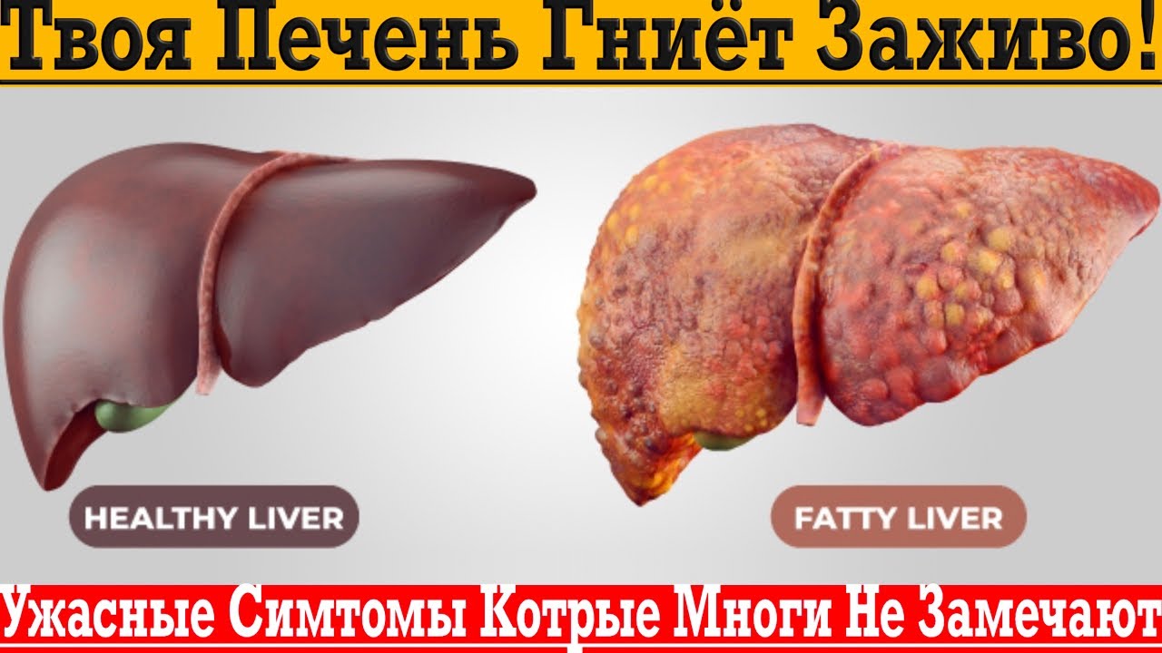 Твоя печень ГНИЁТ ЗАЖИВО! Не пропускай эти симптомы пока СЛИШКОМ ПОЗДНО!