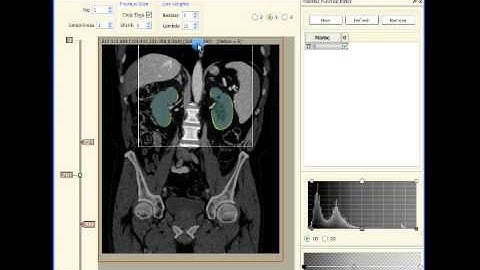 Kidney segmentation in human CT