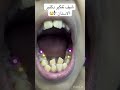 أصعب حالة تقويم أسنان Explore Dentist Dentalesthetics 