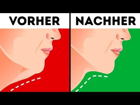 Video: Schwache Kieferlinie: Ursachen Und Ob Sie Behoben Werden Muss