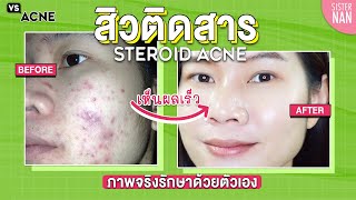 สิวแพ้สารรักษายังไง หน้าใสเร็วที่สุด แพ้ครีม หน้าติดสาร สิวเห่อ หน้าพัง ผิวแดง | แนน Sister Nan