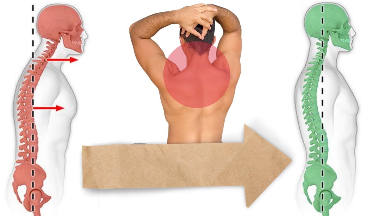 تخلص من حدبة الرقبة في ٥ دقائق | Fix Forward Neck in 5 Minutes