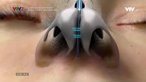 VTV2 - Giải Cứu Mũi Hỏng Của Bác Sĩ Trọng ( Sống khỏe mỗi ngày )