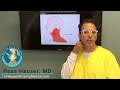 Spasmodic torticollis - cervical dystonia - treatment with prolotherapy - Ross Hauser, MD