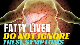 Fatty Liver DO NOT IGNORE These 10 Symptoms