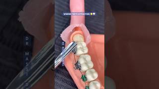 WISDOM TEETH EXTRACTION 😬🦷