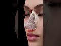 Slide Deviation Rhinoplasty: Correcting Mild Crooked Noses ⭕️ KAMINSKYI