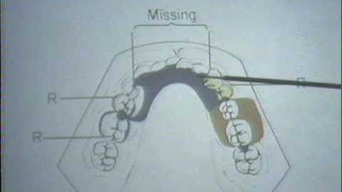 878 Partial Denture Design III