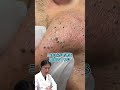 【重症な黒ニキビ】顔中できた黒ニキビ！根本原因を解決するために医療レーザー脱毛を提案します！