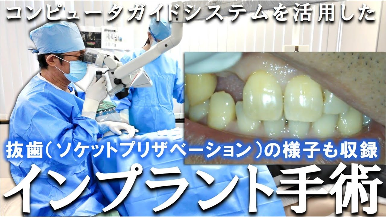 I'll show you everything] Tooth extraction and implant