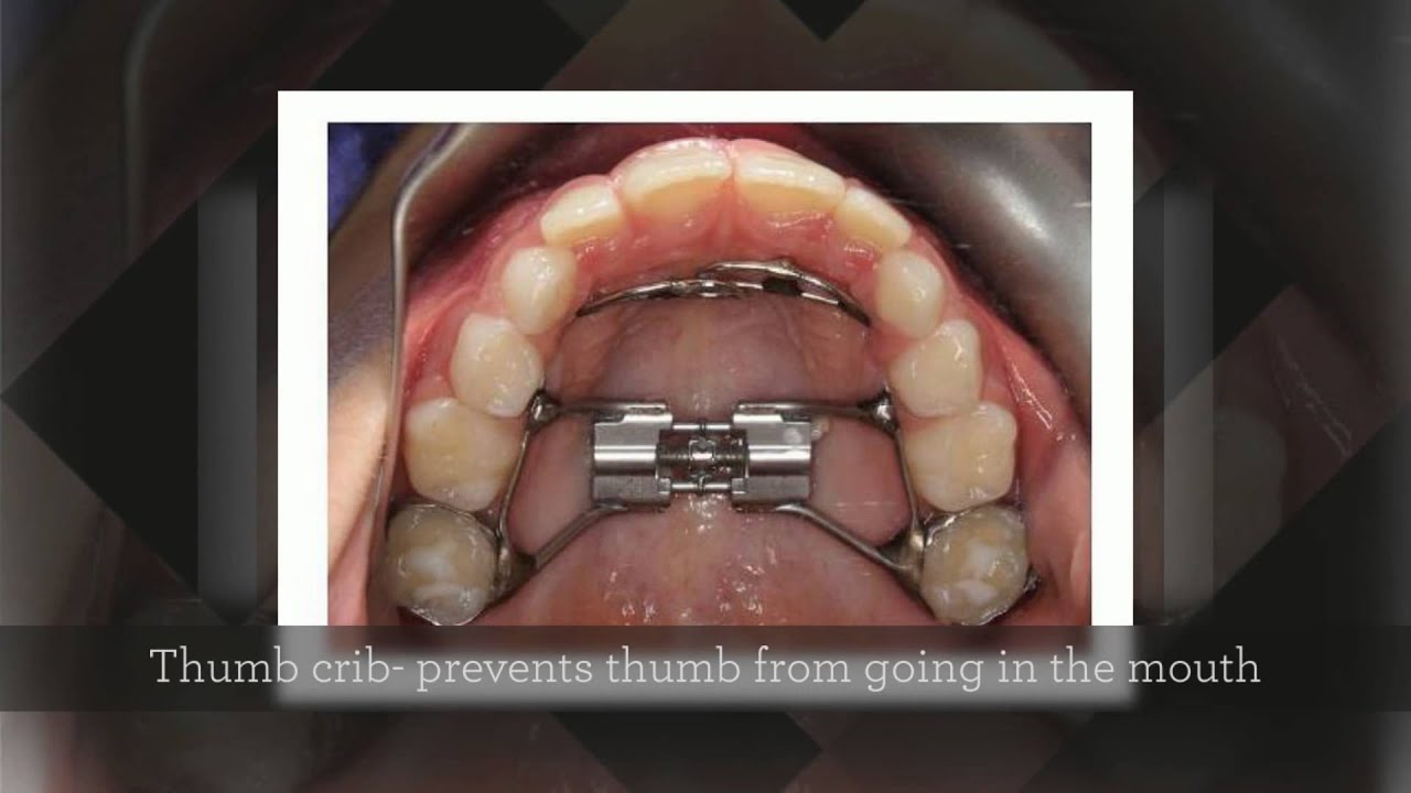 sucking orthodonture thumb