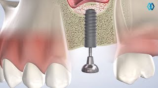 Bone Grafting at North Jersey Oral & Maxillofacial Surgery, Teaneck, NJ screenshot 4