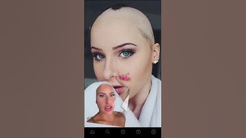 My high school hairloss journey! #bald #alopecia #hairloss