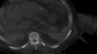 Virtopsy - Robotic Biopsy (CG)