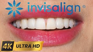 INVISALIGN timelapse - Journey: From Deep Overbite to Confident Smile in 4K  💚