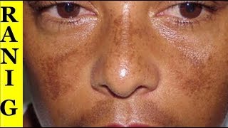 Simple Serf 2 Chezain | Chehre Ki Chaiyan Khatam Karne Ka Asan Totka|Remove Pigmentation By Rani G