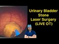 Urinary bladder stone symptoms and laser treatment live surgery dr deepanshu gupta