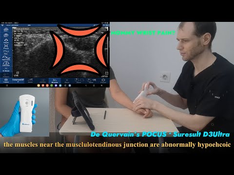 First extensor compartment (De Quervain's) · POCUS · D3Ultra scan preview