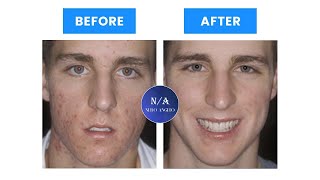 Looksmaxxing Guide : How to get clear skin - (Blackpill Analysis)