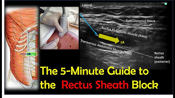 Rectus Sheath Block - A How-To Guide