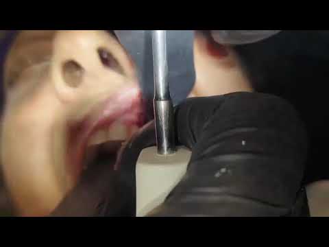 IMMEDIATE EXTRACTION AND IMPLANT PART 1