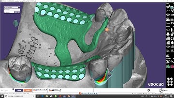 exocad partial framework design demo from Shining 3D