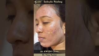 Peeling Treatment | Salicylic peel for pigmentation and acne #peeling #shorts #awishclinic