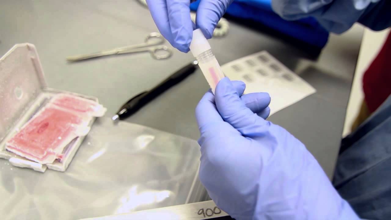 Cord Blood Transplant YouTube