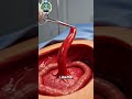 'This organ had to be removed '''Appendectomy Surgery''  #shorts