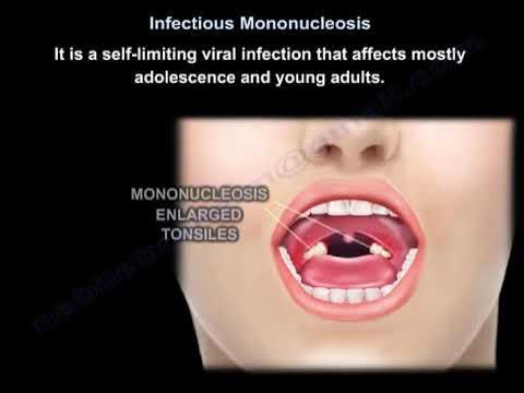 Infectious Mononucleosis (Mono) - the Kissing Disease, Animation 