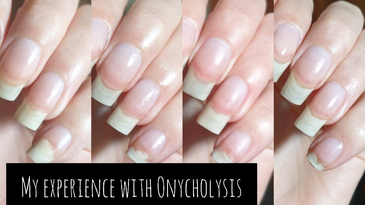 My Experience With Onycholysis Including Pictures And Advice YouTube