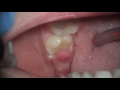 Swollen Gum Around One Tooth But No Pain