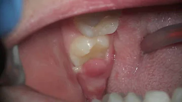 what's this sore gum on wisdom tooth - pericoronitis