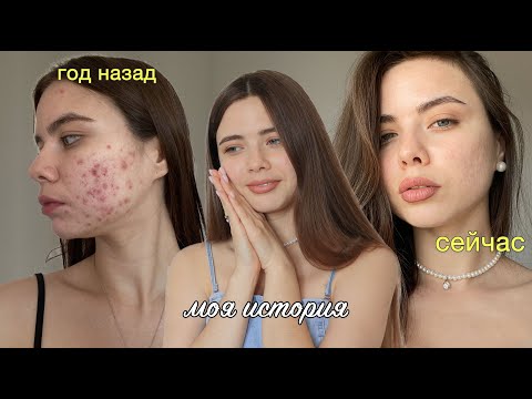 Я ВЫЛЕЧИЛА КОЖУ! 13 ЛЕТ БОРЬБЫ С АКНЕ И ПОВТОРНЫЙ КУРС РОАККУТАНА