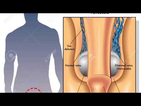 varicocele-|-non-surgical-treatment-|-embolisation-technique-in-hyderabad-for-male-infertility