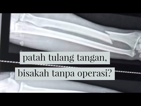 patah 1 tulang tangan radius, apakah bisa tanpa operasi?