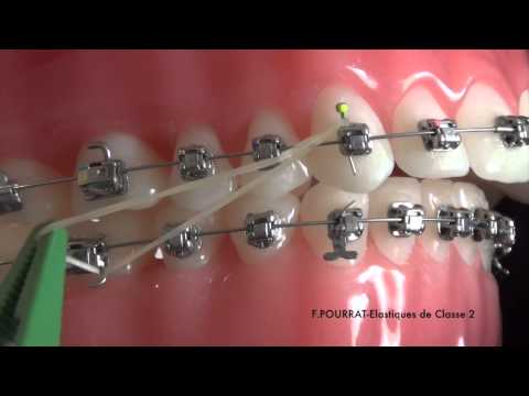 Vidéo: 4 façons de faire face aux appareils orthodontiques à double bloc