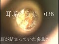耳垢そうじ/耳が詰まっていた大量の耳垢/036