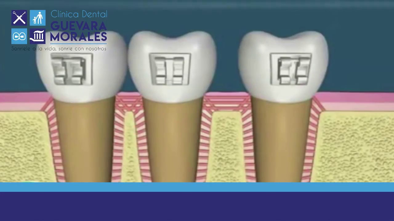 Como se Mueven los Dientes con Brackets YouTube