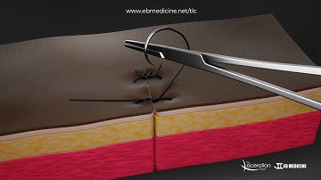 Simple Interrupted Suture Animation