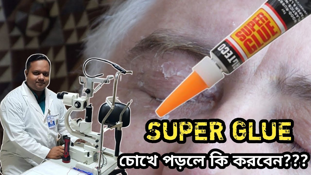চোখে সুপার গ্লু পড়লে কি করবেন??? Eye trauma by super glue. dr. adnan. eye specialist & surgeon.